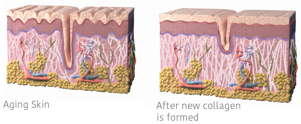 Model of Aging Skin Compared to Skin With New Collagen Formed