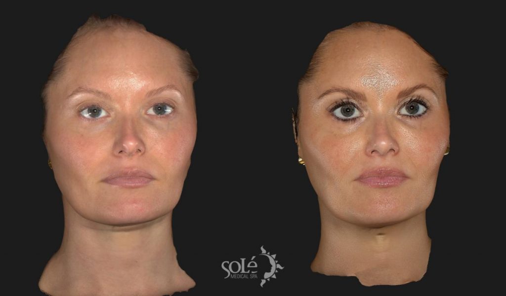 Before and after of woman's face shows how BOTOX/Dysport reshaped her jawline.