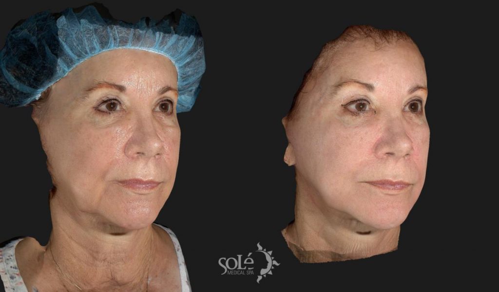 before and after sculptra image of womans face