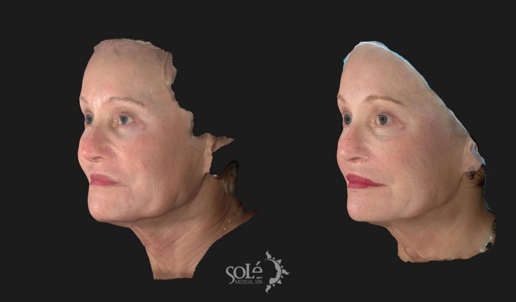 before and after image of sculptra on womans face